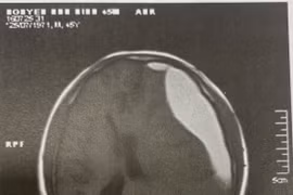 Tụ máu dưới màng cứng sau chấn thương lâu ngày