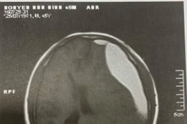 Tụ máu dưới màng cứng sau chấn thương lâu ngày