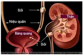 Tắc đường tiểu do uống nước lá đẩy sỏi