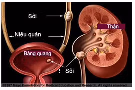 Tắc đường tiểu do uống nước lá đẩy sỏi
