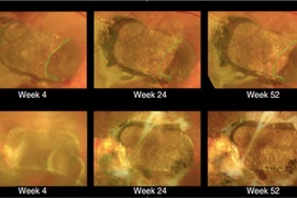 Ghép tế bào gốc vào mắt chữa mù