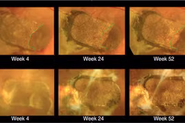 Ghép tế bào gốc vào mắt chữa mù