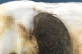  U tóc chiếm gần hết dạ dày bé gái 11 tuổi