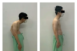 Đục xương chỉnh còng cho bệnh nhân gãy trật đốt sống