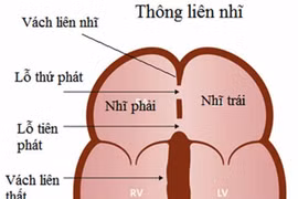 Phát hiện và điều trị thông liên nhĩ sớm