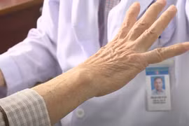 Liệu pháp kích thích não sâu giúp cải thiện chất lượng cuộc sống của bệnh nhân Parkinson.