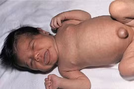 Suy giáp bẩm sinh có chữa được không?