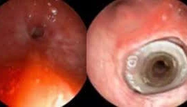 Cấp cứu bệnh nhân suy hẹp khí quản, đe dọa tính mạng