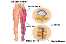 Những biến chứng nguy hiểm của hội chứng thắt lưng