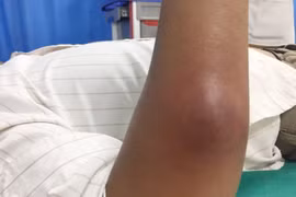 Ápxe vì đắp lá chữa mụn