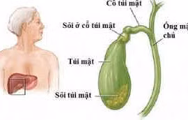 Các phương pháp điều trị sỏi mật hiệu quả