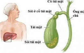 Các phương pháp điều trị sỏi mật hiệu quả