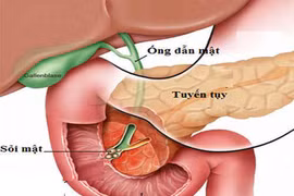 Những sai lầm trong cách ăn gây bệnh sỏi mật