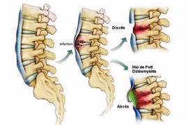 Khi nào nên phẫu thuật nhiễm trùng cốt sống?