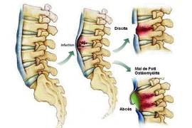 Khi nào nên phẫu thuật nhiễm trùng cốt sống?