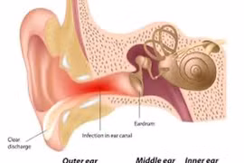 Thổi hơi khi đi máy bay tránh tắc vòi nhĩ gây viêm tai giữa
