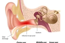Thổi hơi khi đi máy bay tránh tắc vòi nhĩ gây viêm tai giữa