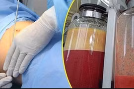 Tử vong sau 14 giờ hút mỡ bụng ở thẩm mỹ viện