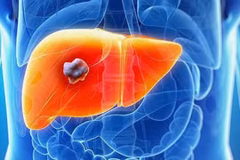 6 bệnh ung thư người béo phì dễ mắc