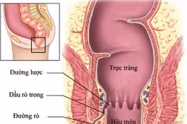 Rò hậu môn có nguy hiểm không?