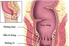 Rò hậu môn có nguy hiểm không?