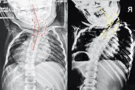 Bỏ qua thời điểm vàng can thiệp, bé 6 tuổi vẹo cột sống lệch đầu