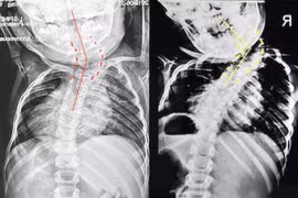 Bỏ qua thời điểm vàng can thiệp, bé 6 tuổi vẹo cột sống lệch đầu