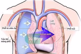 Ho, đau ngực cẩn thận tràn khí màng phổi