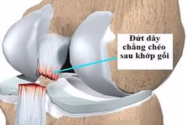 Tổn thương dây chằng chéo sau có phải mổ?