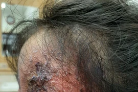 Bé Y bị tổn thương da mặt nghiêm trọng do mẹ tự mua thuốc trị nấm