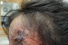 Bé Y bị tổn thương da mặt nghiêm trọng do mẹ tự mua thuốc trị nấm