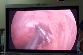 Phẫu thuật ruột thừa thấy xương cá đâm xuyên thành ruột