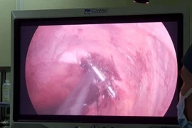 Phẫu thuật ruột thừa thấy xương cá đâm xuyên thành ruột