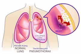 Tràn dịch màng phổi - biến chứng của nhiều bệnh
