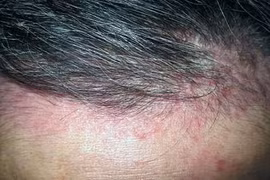 Mọc mụn do dùng keo giữ dáng tóc 