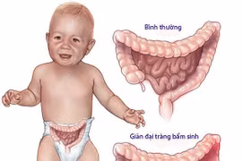 Trẻ đại tiện khó cẩn thận bệnh phình đại tràng nguy hiểm