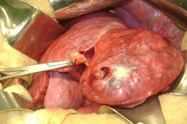  Biến chứng nguy hiểm của sỏi đường mật trong gan