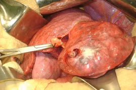  Biến chứng nguy hiểm của sỏi đường mật trong gan