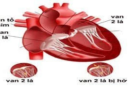 Các nguyên nhân gây hở van 2 lá