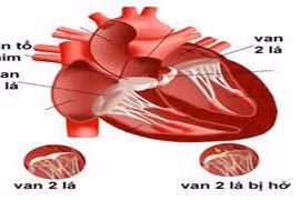 Các nguyên nhân gây hở van 2 lá