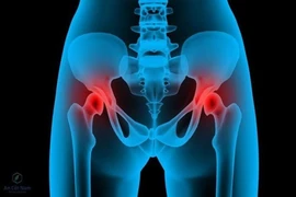 Có nên thay khớp háng hư?