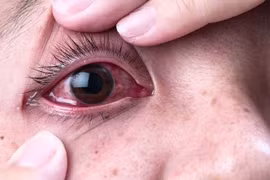 Hỏng giác mạc do hóa chất