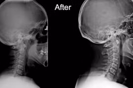 Mất đường cong sinh lý cổ gây nhiều bệnh lý khó lường