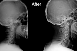 Mất đường cong sinh lý cổ gây nhiều bệnh lý khó lường