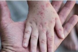 Đậu mùa khỉ âm thầm lây lan tới trẻ em