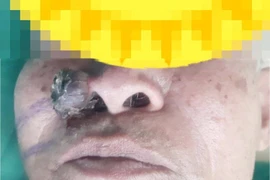 Chủ quan vết sần thành u cánh mũi