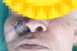 Chủ quan vết sần thành u cánh mũi