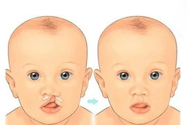 Khi nào nên phẫu thuật hở vòm