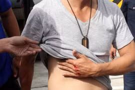 Chấn thương ngực kín gãy xương sườn được truyền giảm đau