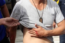 Chấn thương ngực kín gãy xương sườn được truyền giảm đau